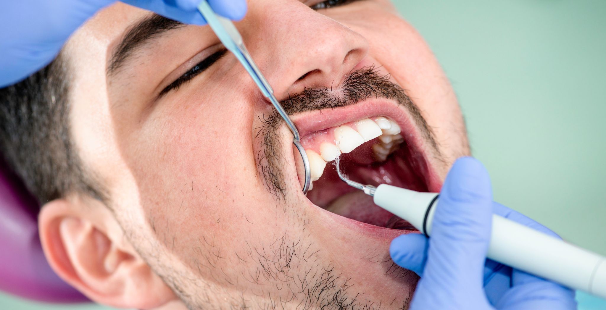 Dental plaque removal methods, How to remove plaque, Plaque cleaning techniques, Professional dental cleaning, Plaque removal at dentist, Home remedies for plaque, Removing plaque buildup